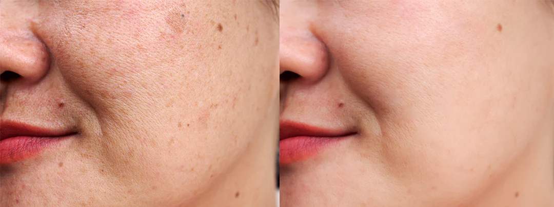 اثربخشی محصولات ضد لک و روشن کننده پوست
