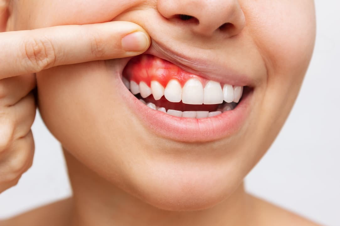 عوارض و مضرات استفاده نادرست از نخ دندان