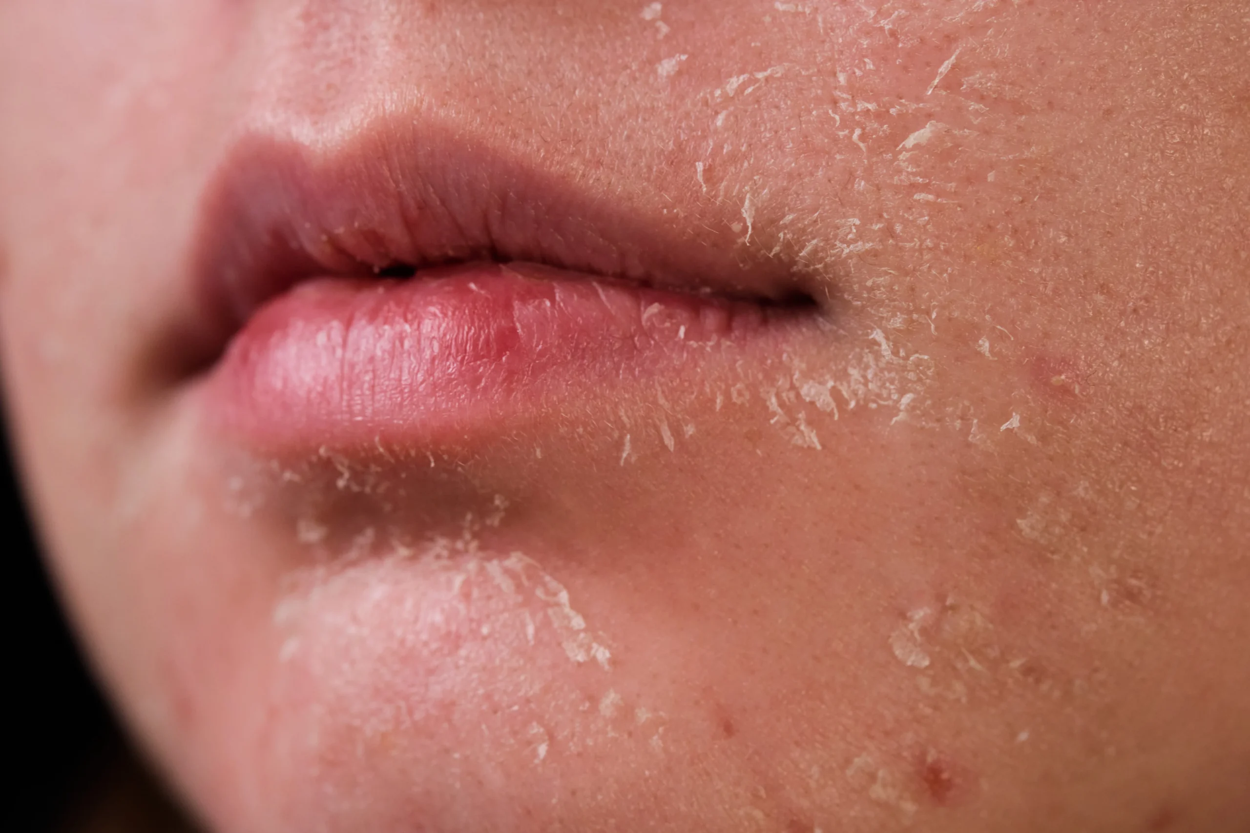 خشکی پوست بعد از استفاده نادرست از ژل شستشوی صورت