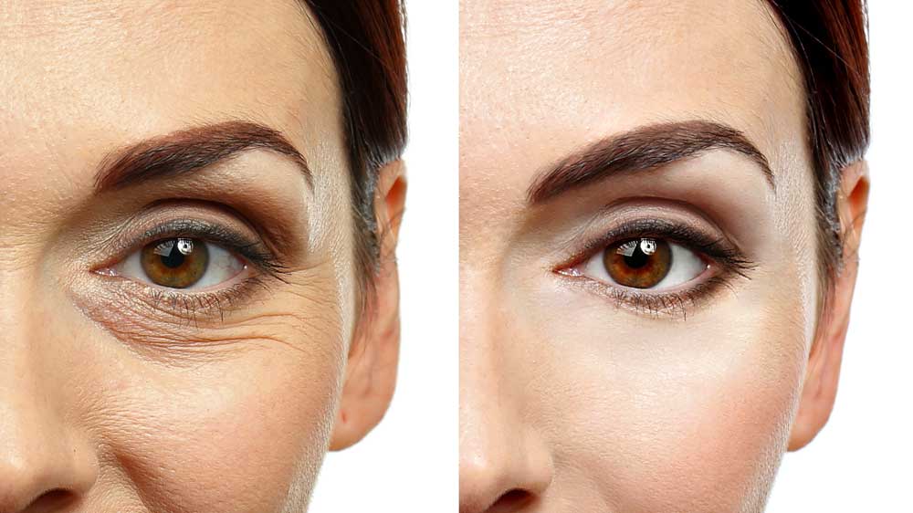 بهبود پوست دور چشم با استفاده از کرم های دور چشم