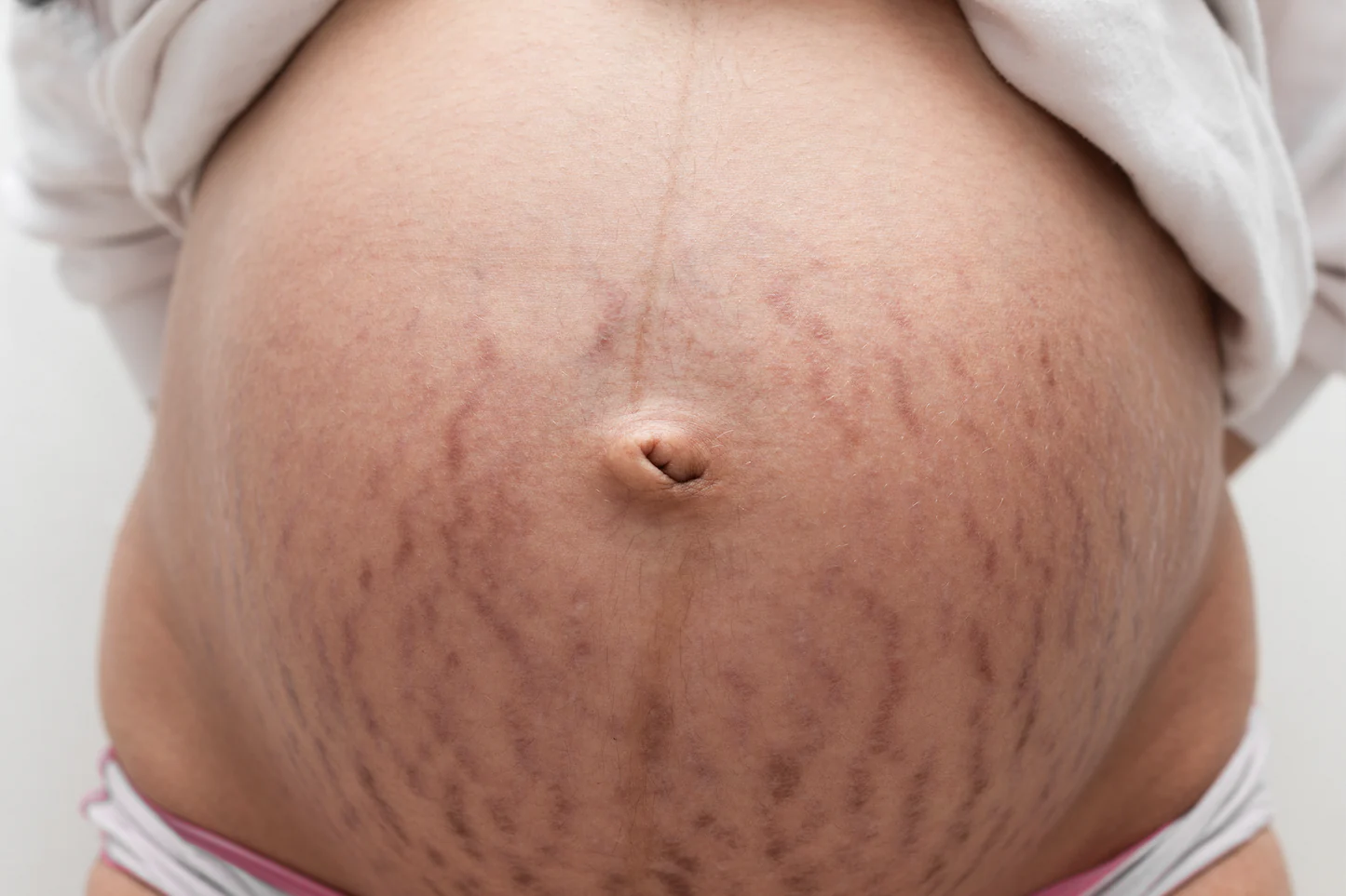 ترک های پوستی به دلیل بارداری