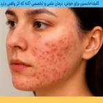 کلیندامایسین برای جوش
