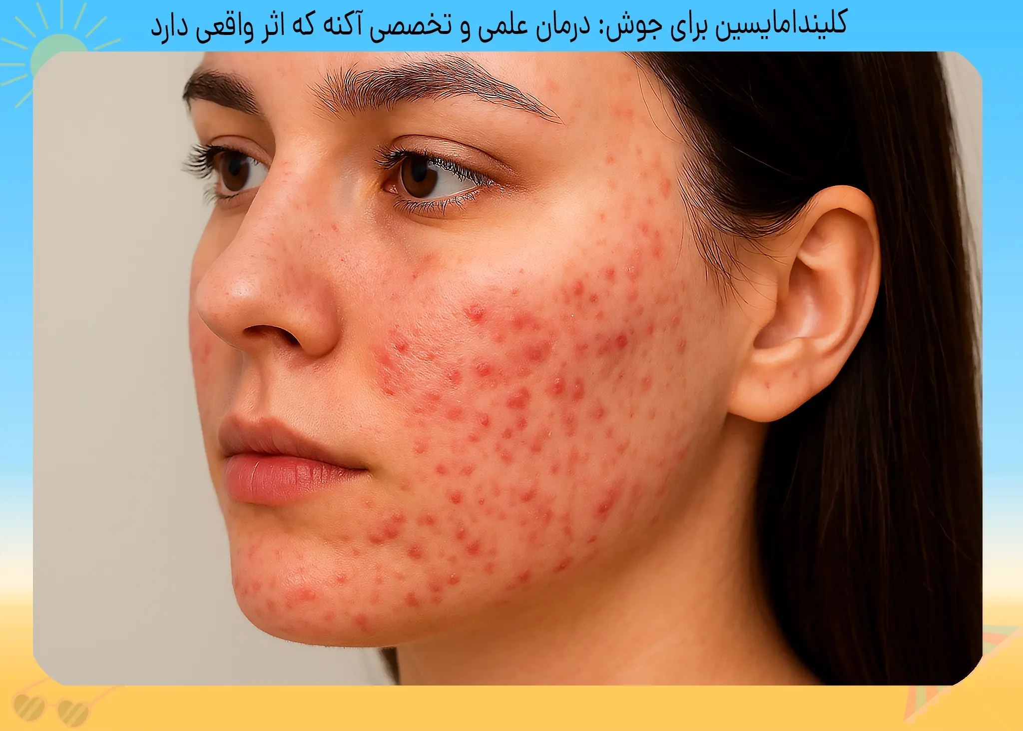 کلیندامایسین برای جوش