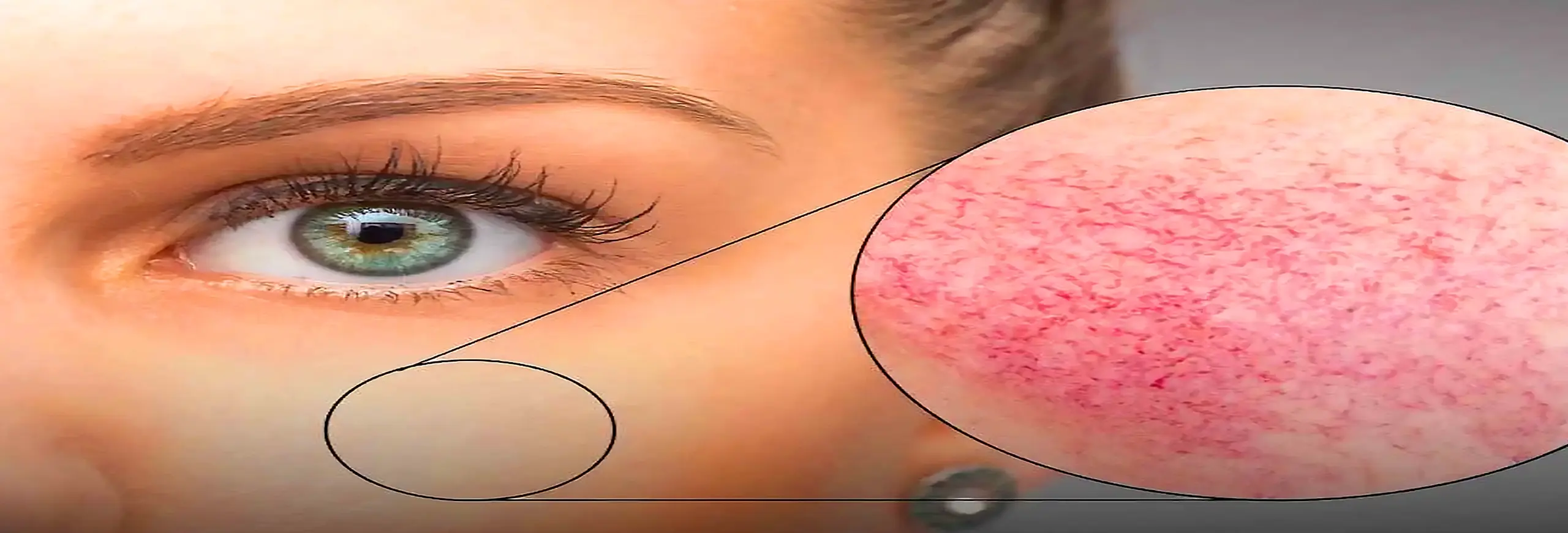 درمان خانگی قرمزی پوست صورت