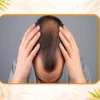 ریزش مو ارثی از چند سالگی شروع میشود