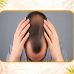 ریزش مو ارثی از چند سالگی شروع میشود