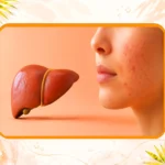 نشانه های کبد چرب و جوش صورت