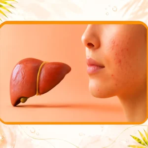نشانه های کبد چرب و جوش صورت